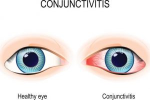 ASK us about: Conjunctivitis